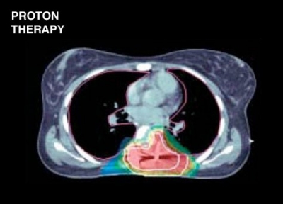 پروتون تراپی در درمان سارکوما