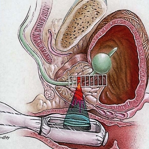 هایفو (HIFU) در درمان سرطان پروستات